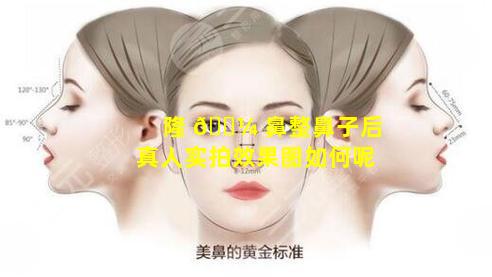 隆 🐼 鼻整鼻子后真人实拍效果图如何呢